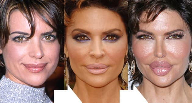 Lisa Rinna Plastic Surgery Before And After 1