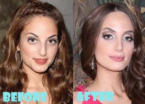 Mila Kunis Before And After Plastic Surgery 1
