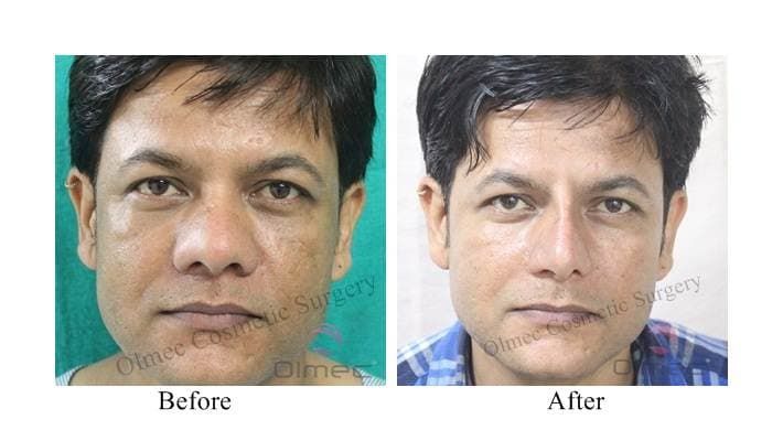 Nose Plastic Surgery Before And After In India 1
