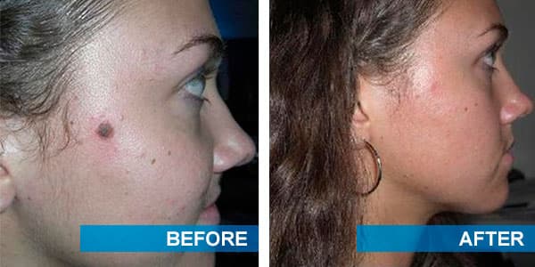 Plastic Surgery Facial Mole Removal Before And After Photos 1