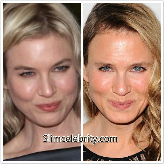 Renee Zellweger Plastic Surgery Before And After 2013 1