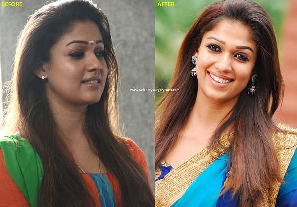 Tollywood Actress Before And After Plastic Surgery 1
