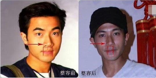 Zheng Kai Plastic Surgery Before And After 1
