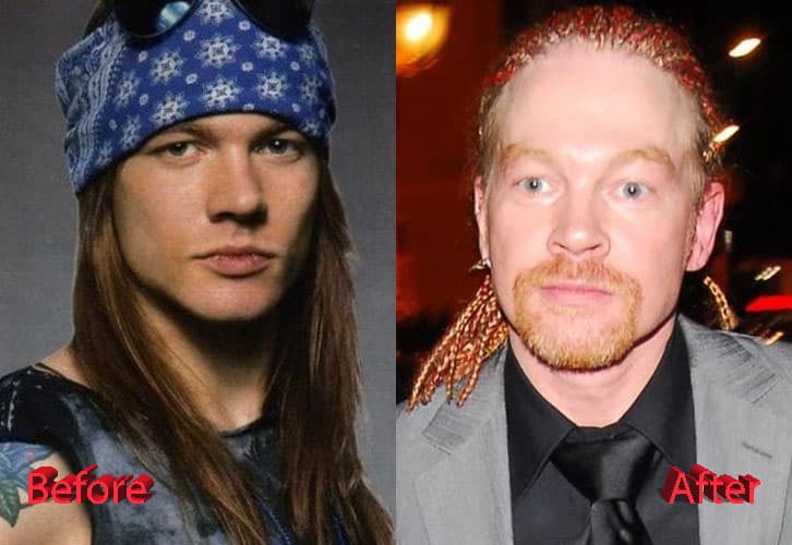 Axl Rose Before And After Plastic Surgery photo - 1