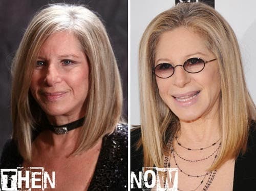 Barbra Streisand Plastic Surgery Before After photo - 1