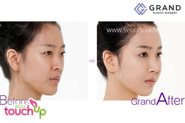 Best Plastic Surgery Before And After Korean photo - 1