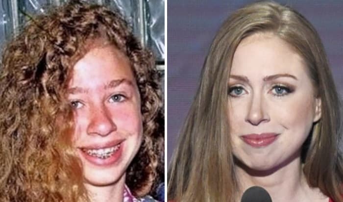 Chelse Clinton Plastic Surgery Before And After photo - 1