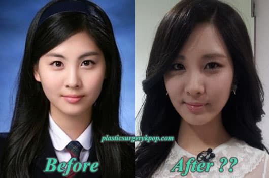 Girls Generation Members Before And After Plastic Surgery photo - 1