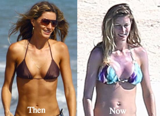 Gisele Before And After Plastic Surgery photo - 1
