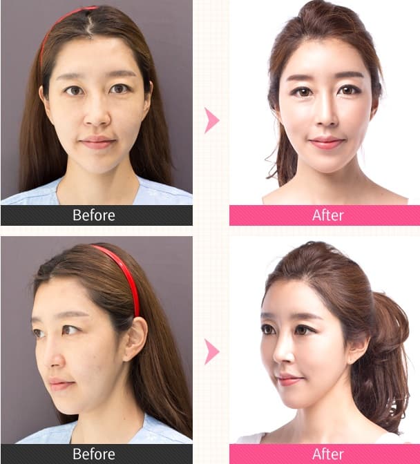 Korean Plastic Surgery Before After photo - 1