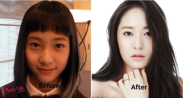 Kpop Plastic Surgery Before And After photo - 1