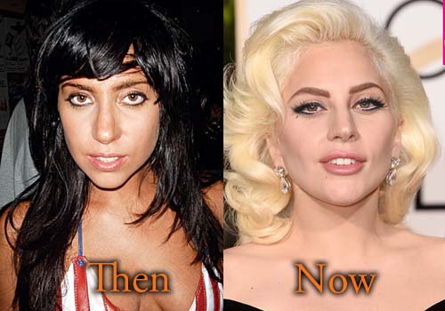 Lady Gaga Plastic Surgery Before And After 2017 photo - 1