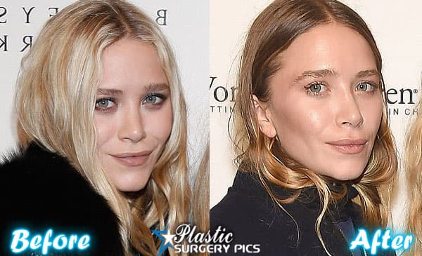 Mary Kate Olsen Plastic Surgery Before And After photo - 1