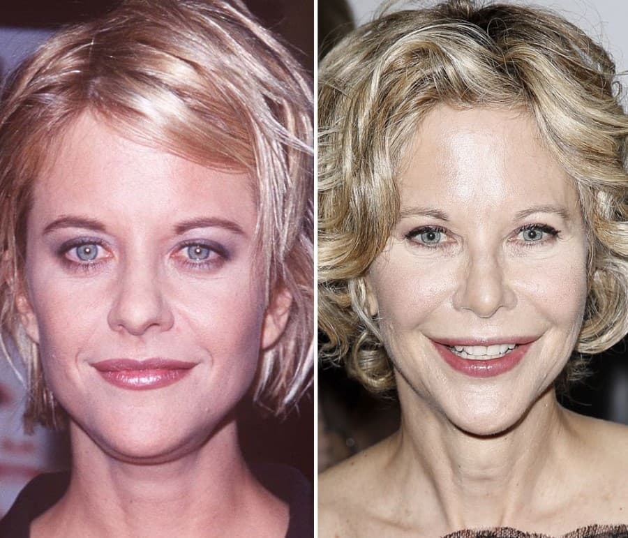 Movie Stars Before And After Plastic Surgery photo - 1