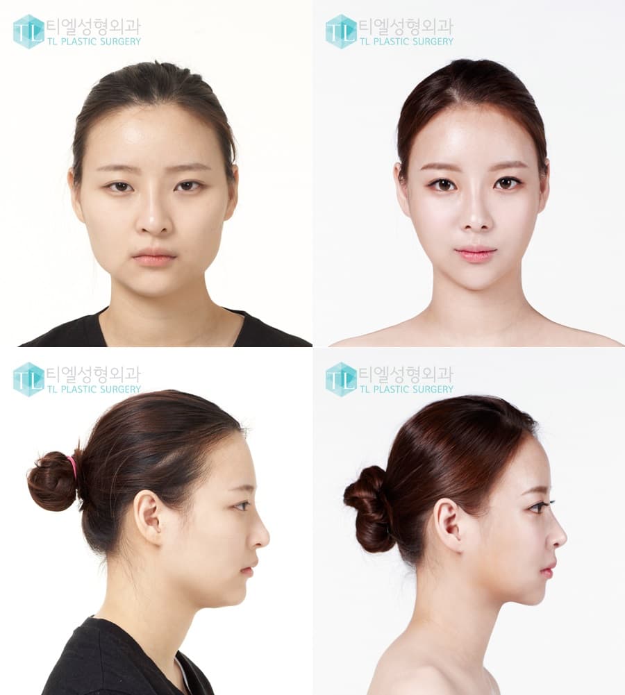 Nana Plastic Surgery Before And After photo - 1