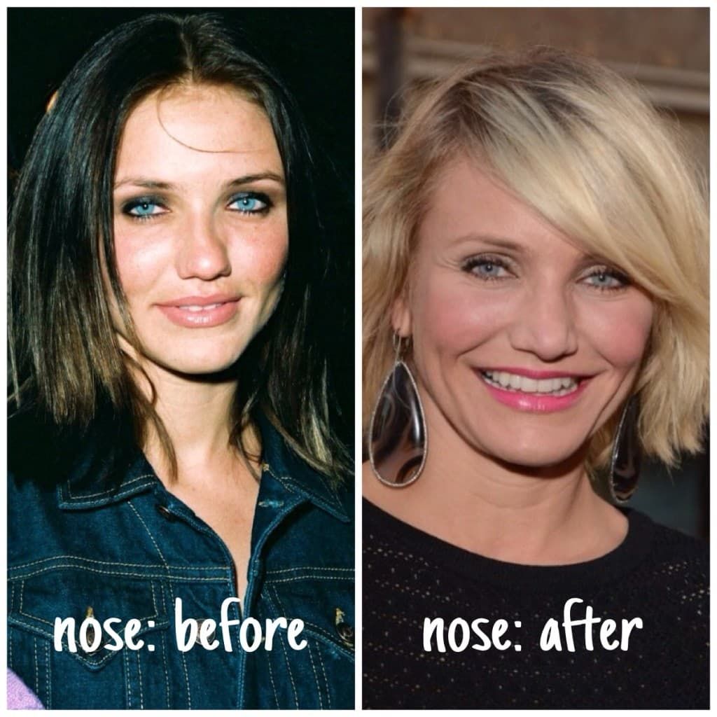 Nose Job Plastic Surgery Men Before And After photo - 1