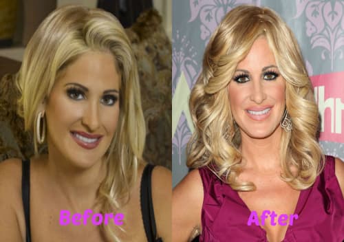 Plastic Surgery Before And After Real Housewives photo - 1