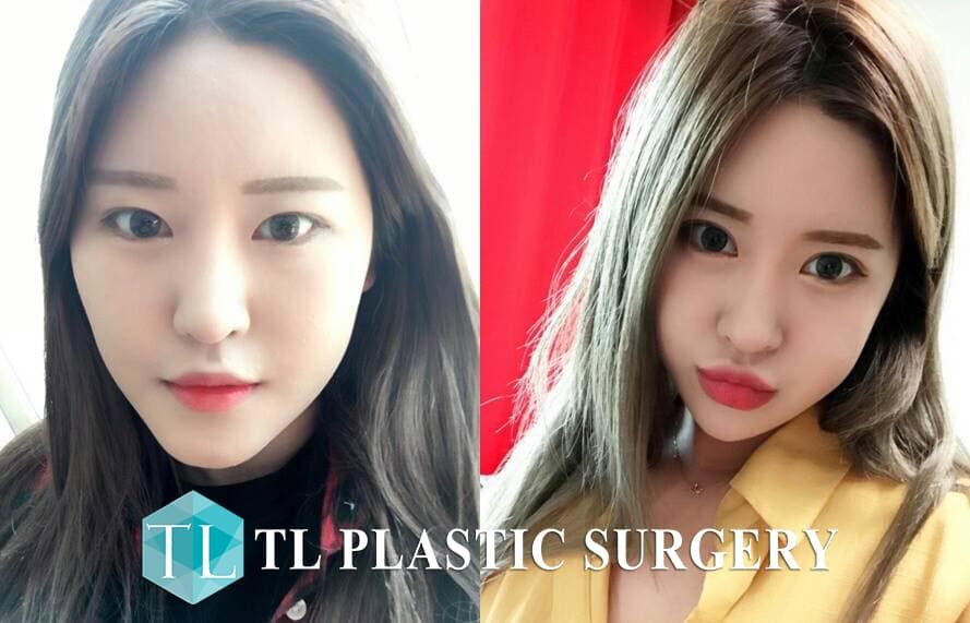 Plastic Surgery In Korea Before And After photo - 1