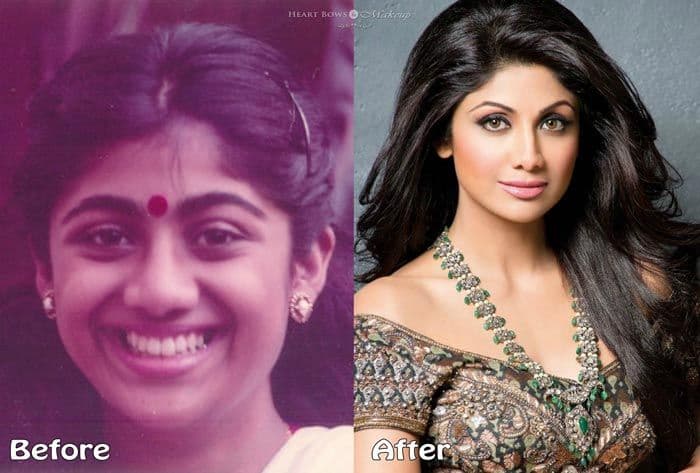 Plastic Surgery Indian Celebrities Before And After photo - 1