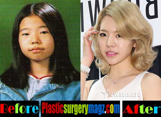 Plastic Surgery Snsd Before After Pictures photo - 1
