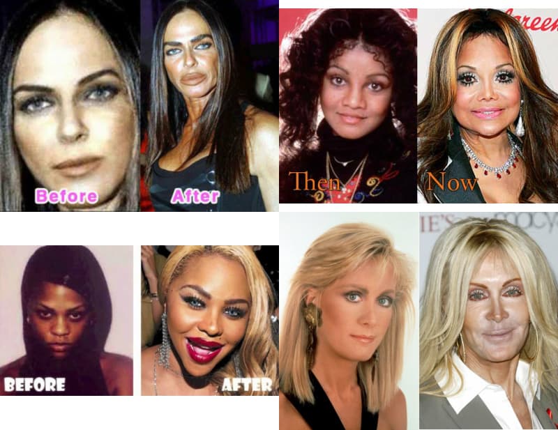 Worst Celebrities Plastic Surgery Before And After photo - 1